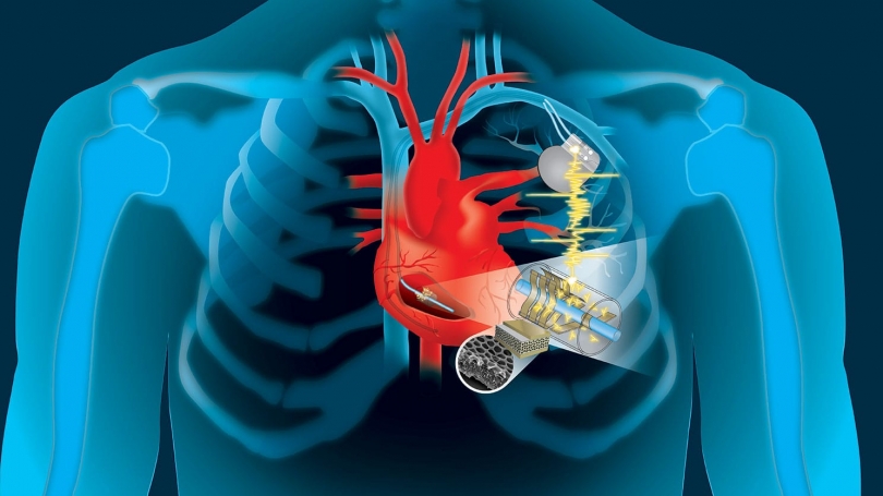 pacemakers implanted graphic